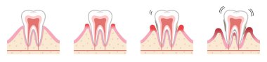 Periodontal hastalık. Periodontal hastalığın kesitsel bir illüstrasyonu..