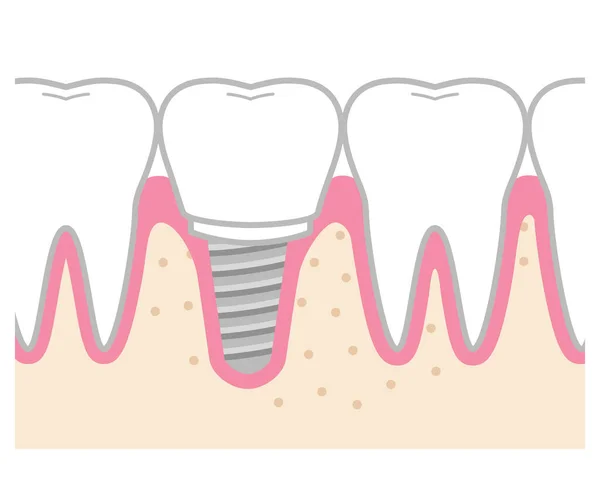 Dents Traitées Par Implant Illustration Une Dent Traitée Par Implant — Image vectorielle