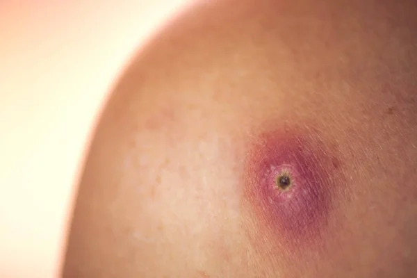 Acılı Furamcası Olan Bir Kadın Derisi Nsanlar Tıp Cilt Bakımı — Stok fotoğraf