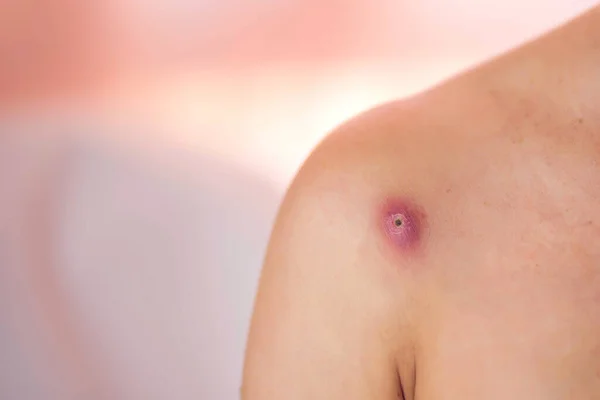 Acılı Furamcası Olan Bir Kadın Derisi Nsanlar Tıp Cilt Bakımı — Stok fotoğraf