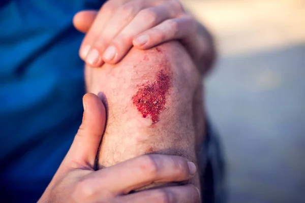 Kecelakaan Darurat Membuka Luka Lecet Lutut Kaki Trauma Orang Orang — Stok Foto
