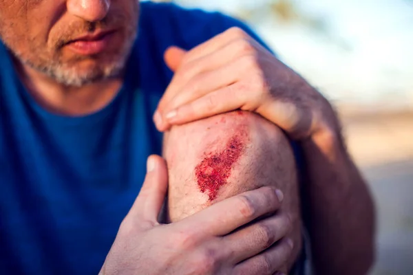 Kecelakaan Darurat Membuka Luka Lecet Lutut Kaki Trauma Orang Orang — Stok Foto