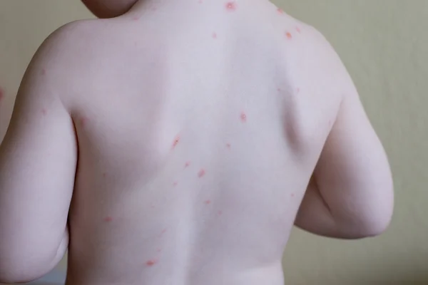 Chickenpox disease — Stock Photo, Image