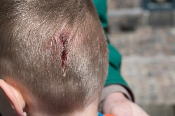 Herida en lesión en la cabeza —  Fotos de Stock