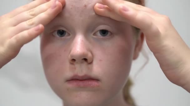 Tiener meisje met probleem huid onderzoekt haar gezicht in de badkamer spiegel — Stockvideo