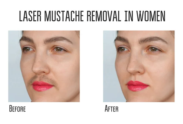 Wax, laser hair removal of the mustache for women — Stock Photo, Image