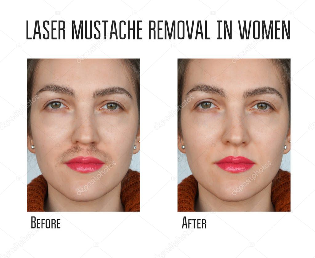 Cera depilacion laser del bigote para las mujeres. Depilacion facial Foto de stock nnfotograf 432308508