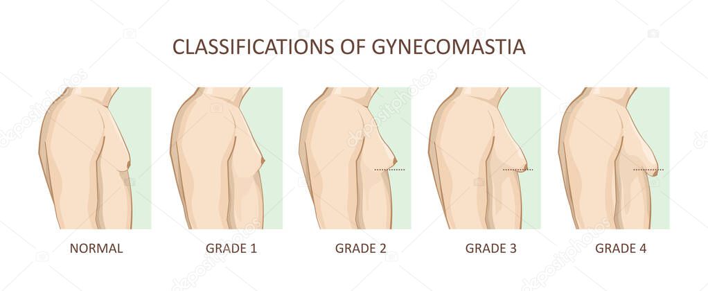 Classification of gynecomastia. Enlargement of the male breast