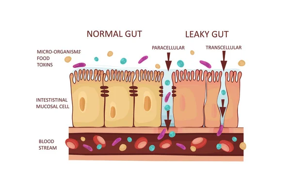 Leaky-Darm-Syndrom oder Darmdurchlässigkeitsdiagramm. Autoimmunerkrankung. Vektorillustration — Stockvektor