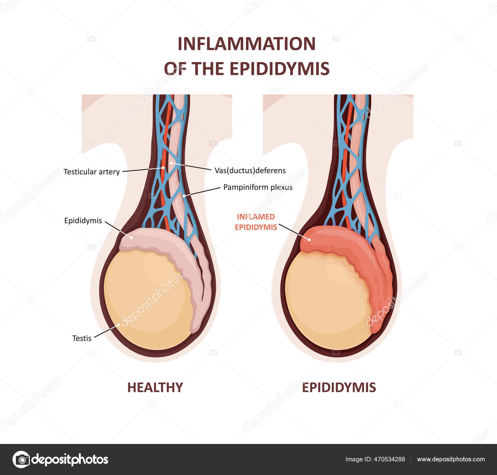 Inflammation of the epididymis. comparison and difference of Healthy