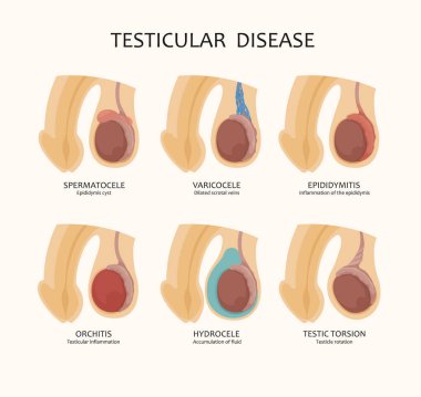 Çeşitli testis hastalıkları