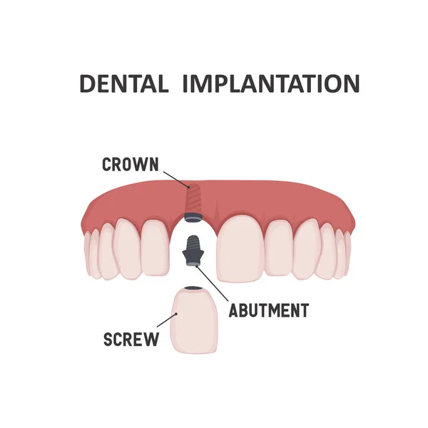 Diş implantı yapısı. — Stok Vektör