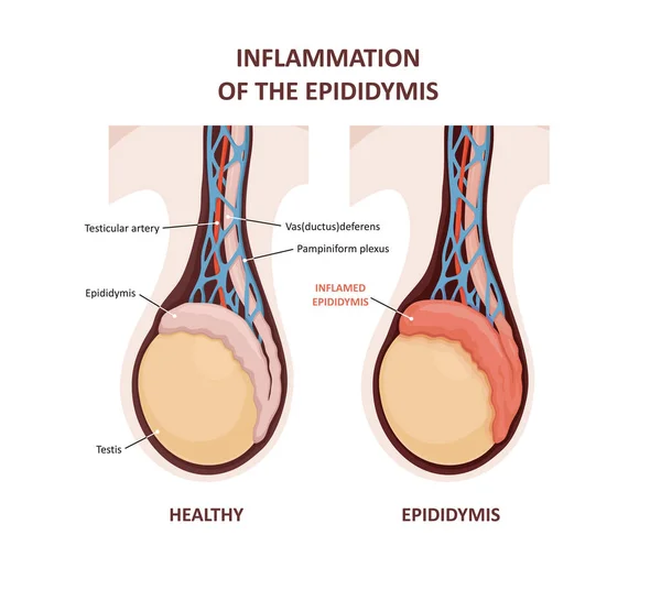 Inflammation of the epididymis. comparison and difference of Healthy testicle and testicle with infection. Signs and symptoms of the disease — Vector de stock