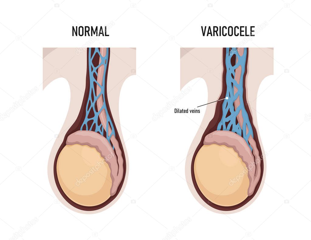 Varicocele in male reproductive system. Dilated veins.