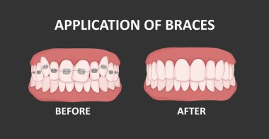 Diş telleri, önce ve sonra. Ortodontik tedavi. Çarpık dişler.