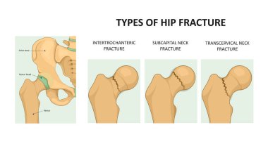 Kalça kırığı. Femoral boyun kırığı. Tıbbi vektör illüstrasyonu