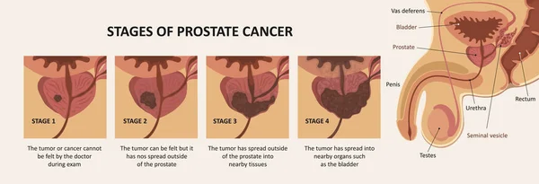 Stades du cancer de la prostate. Anatomie du système reproducteur masculin — Image vectorielle