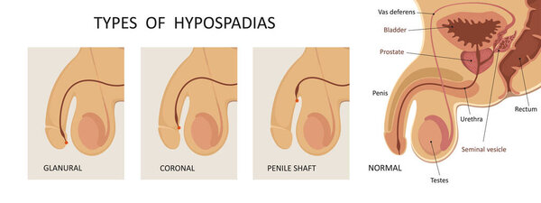Types of hypospadias. Sideview opening of urethra.