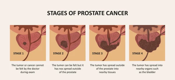 Stadier av prostatacancer. Tumören växer och tränger in i organ och vävnader. — Stock vektor