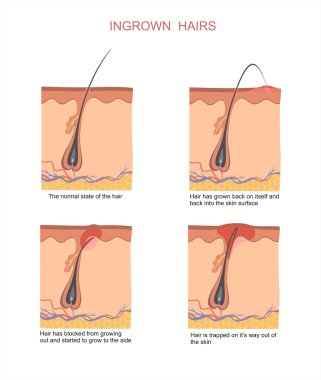 Ingrown hairs when shaving and depilation clipart
