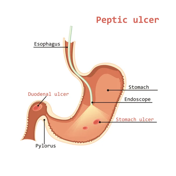 Úlcera de estómago. El endoscopio es un tubo largo, flexible e iluminado . — Vector de stock