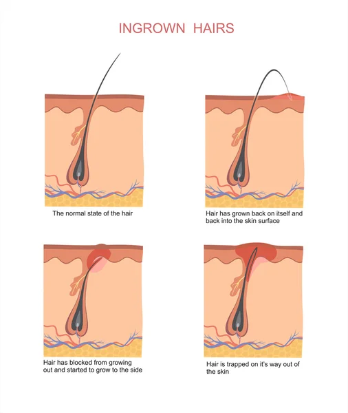 Ingegroeide haren wanneer scheren en ontharing — Stockvector