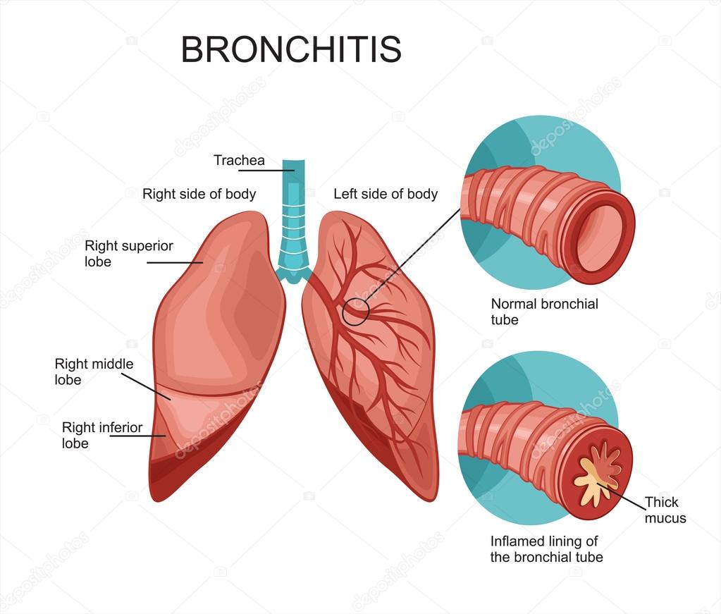 Lungs during Bronchitis