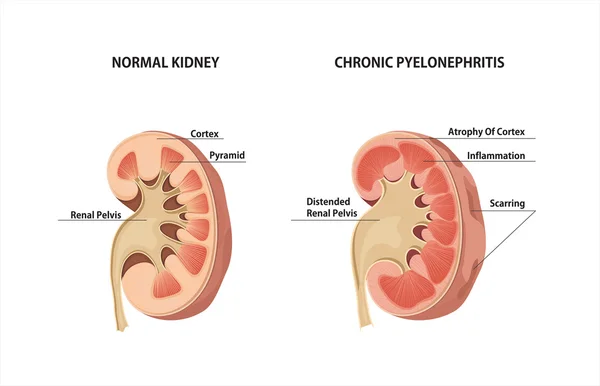 Normal böbrek ve kronik Pyelonephritis. — Stok Vektör