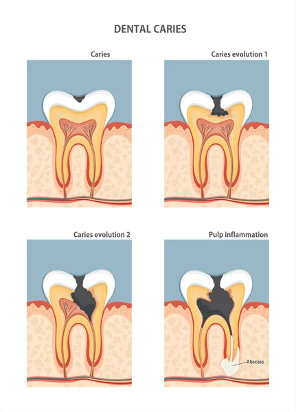 Vznik zubního kazu — Stockový vektor