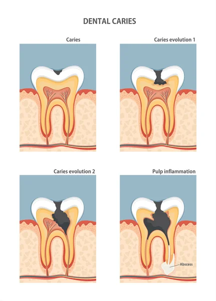 Desenvolvimento da cárie dentária — Vetor de Stock