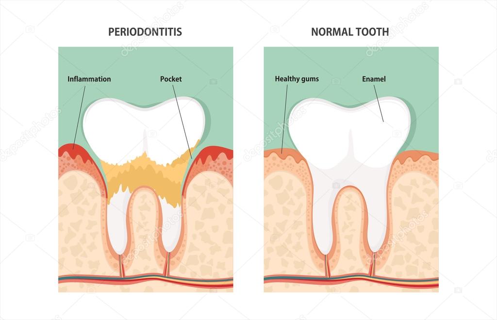 Tooth periodontal disease