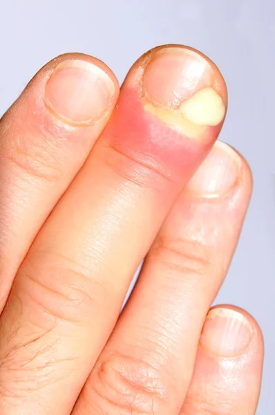 손 감염 — 스톡 사진