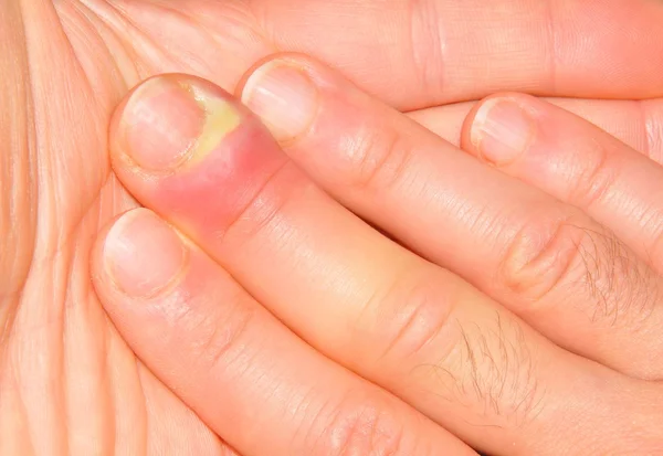 손 감염 — 스톡 사진