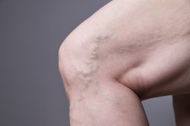 Varicose veins closeup. Thick female legs clipart