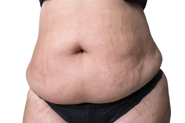 Fat female belly after pregnancy, stretch marks closeup — Stock Photo, Image