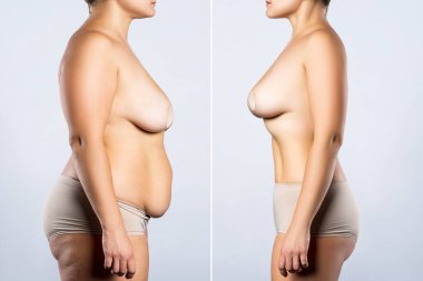 Göğüs büyütme ameliyatından önce ve sonra, büyük silikon göğüslü bir kadın, düzeltme ameliyatından sonra ve gri arka planda liposuction.