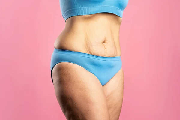 Tummy Tuck Flabby Skin Fat Belly Plastic Surgery Concept Pink — Stock Photo, Image