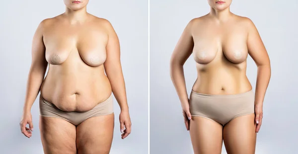 Avant Après Concept Augmentation Mammaire Femme Avec Gros Seins Silicone — Photo