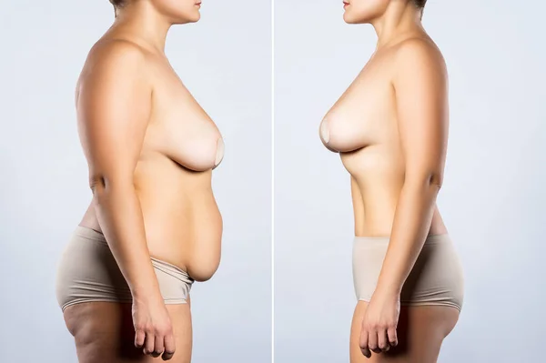 Breast Augmentation Concept Woman Large Silicone Breasts Correction Surgery Liposuction — Stock Photo, Image