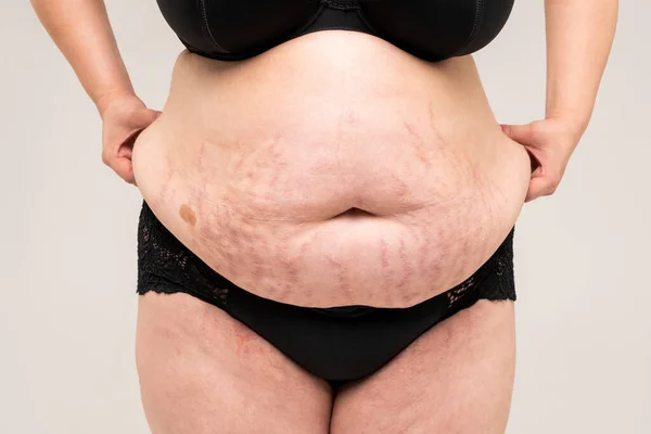 Tummy tuck, flabby skin with stretch marks on a fat belly, plastic surgery concept on gray background