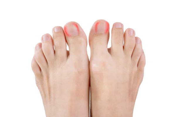 Ingrown Toenails Woman Foot Isolated White Background Pain Big Toe — Stock Photo, Image