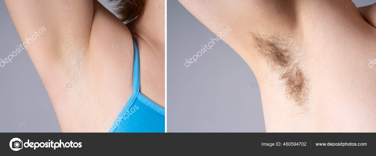 волосатые подмышки После Удаления Волос Подмышкой Женские Волосатые Подмышки Чистая Кожа После — Стоковое фото © starast #460594702
