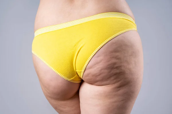 Nadváha Žena Tlustými Boky Hýždě Obezita Ženské Tělo Celulitidou Šedém — Stock fotografie