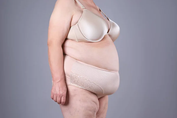 Abdominoplastia Piel Flácida Sobre Vientre Gordo Concepto Cirugía Plástica Sobre — Foto de Stock