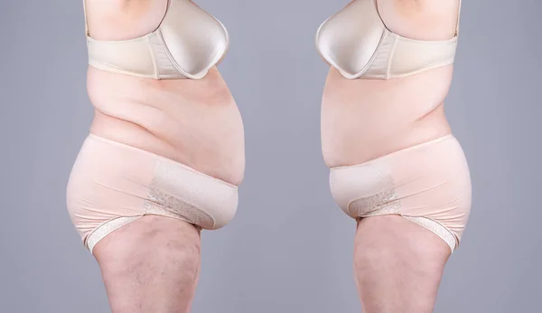 Женское Тело После Потери Веса Сером Фоне Концепция Пластической Хирургии — стоковое фото
