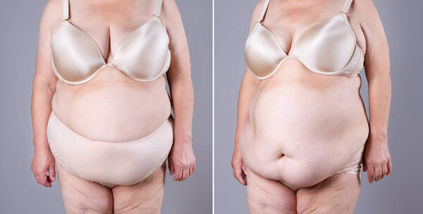 Woman's body before and after weight loss on gray background, plastic surgery concept