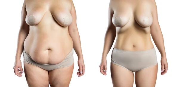 Breast Augmentation Concept Woman Large Silicone Breasts Correction Surgery Liposuction — Foto Stock