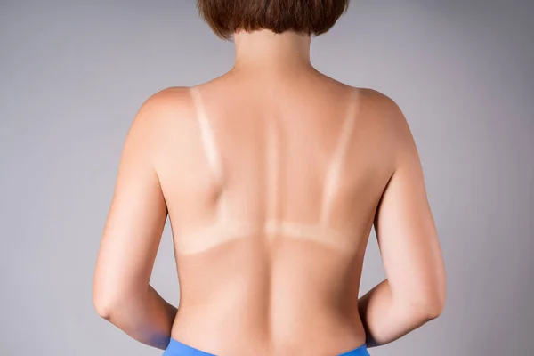 日焼けした女性 日焼けした背中のマーク スタジオグレーの背景 — ストック写真