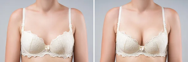 在隆乳前和隆乳后 有较大硅胶乳房的妇女在灰色背景下矫正手术后 — 图库照片