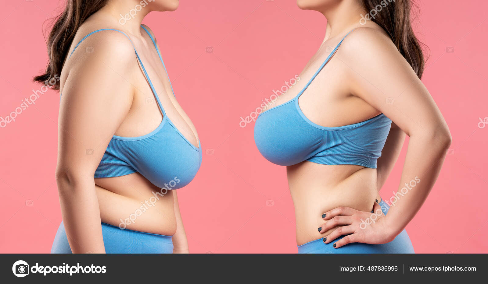 Breast Augmentation Concept Woman Very Large Silicone Breasts Correction  Surgery Stock Photo by ©starast 487836996